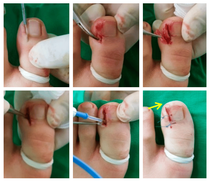 About Ingrown Toenail Surgery