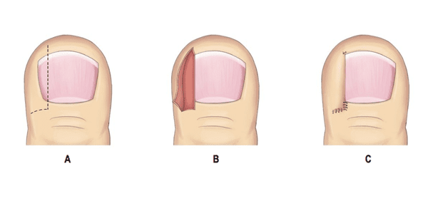 Ingrown Toenail Surgery - Foot & Ankle Experts